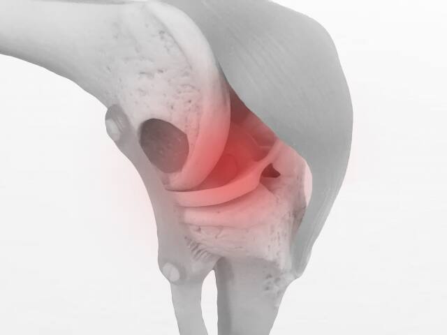 変形性膝関節症はヒアルロン酸注射や塗り薬でも効果はある？